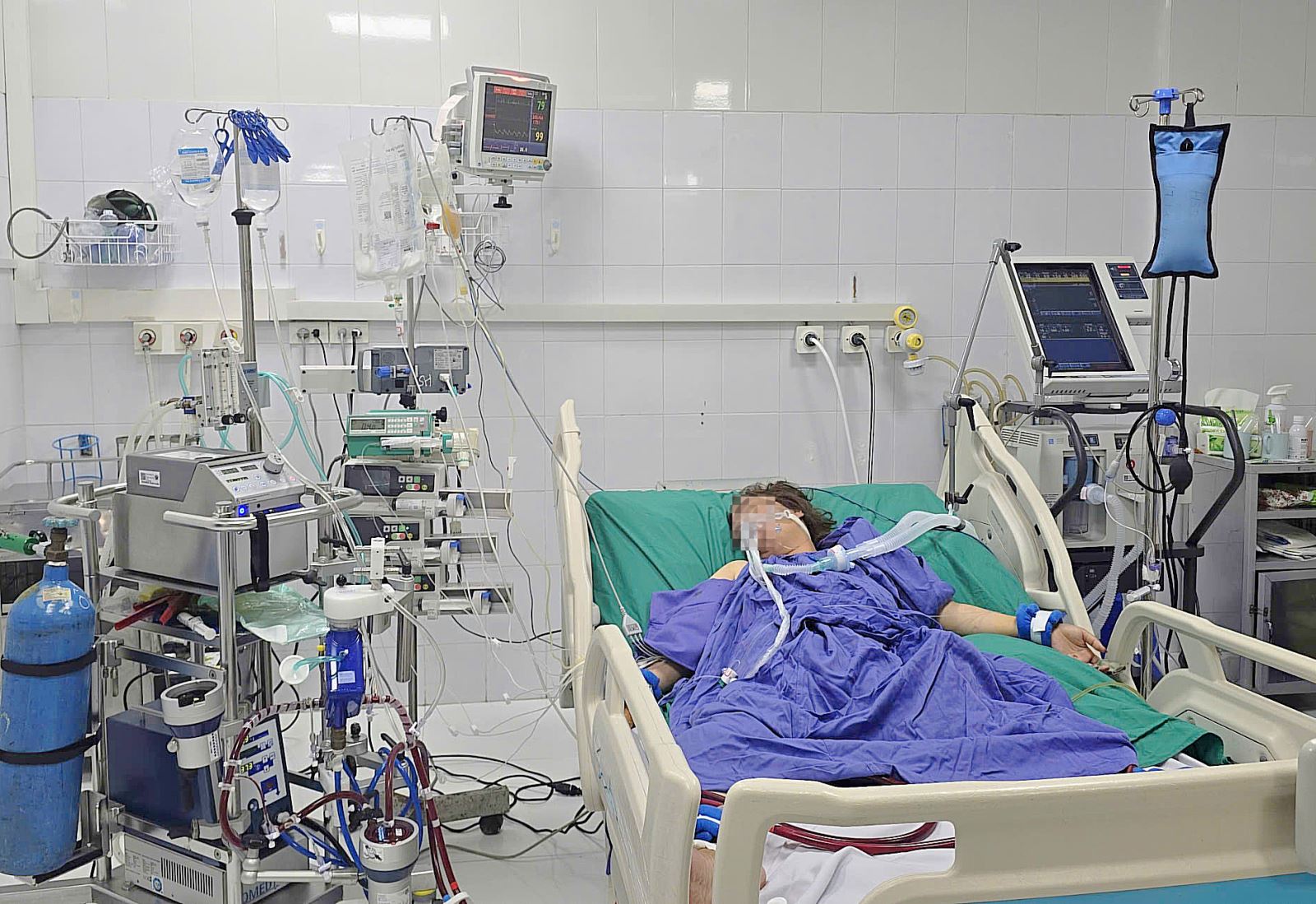 Người phụ nữ 43 tuổi nguy kịch sau 5 ngày ho, sốt - Ảnh 1.