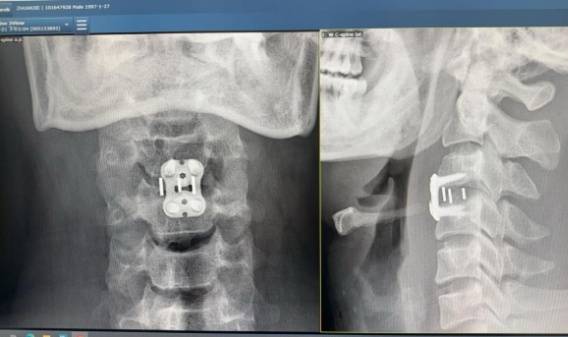 Chàng trai 27 tuổi suýt liệt nửa người sau cú bẻ cổ khi đi tẩm quất chữa đau vai gáy - Ảnh 2.