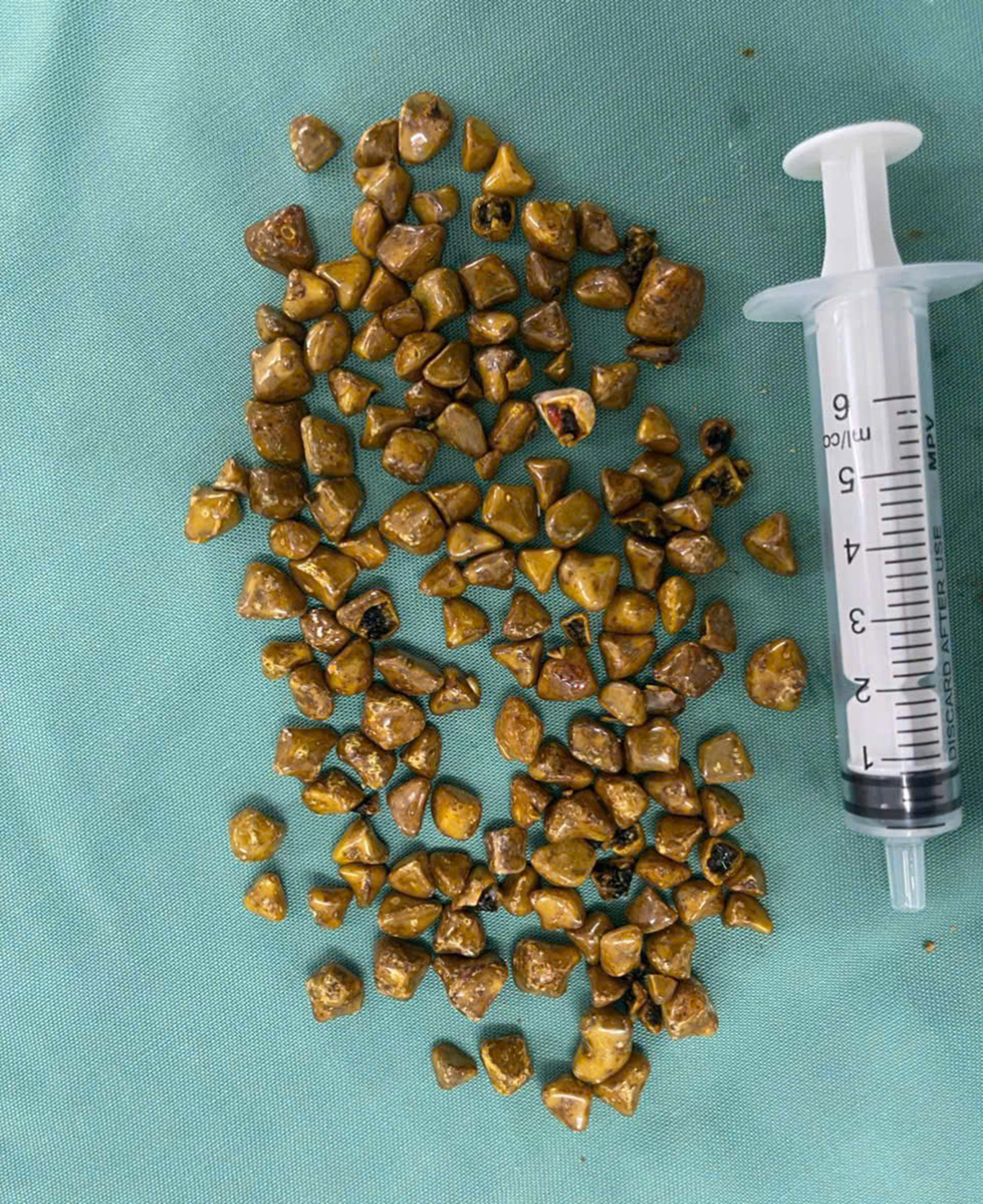 Người phụ nữ 39 tuổi đau bụng dữ dội, bác sĩ gắp ra thứ 
