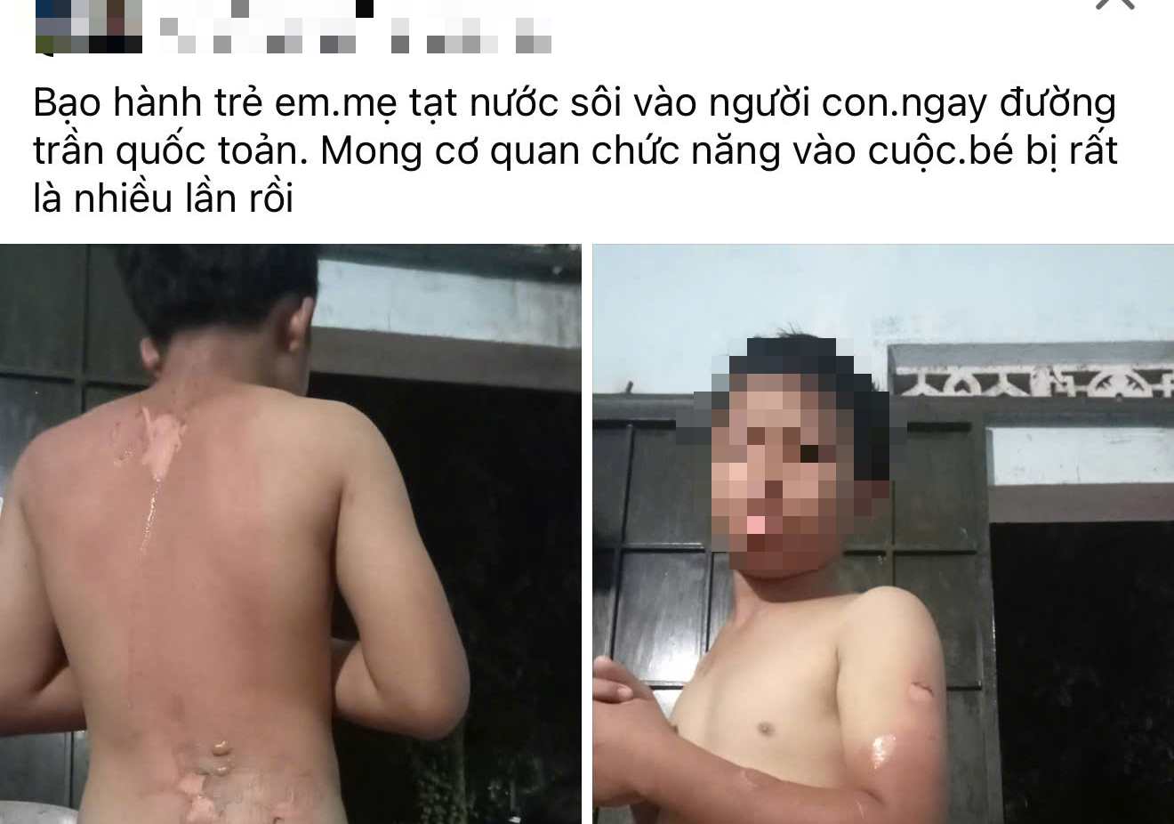 Công an vào cuộc vụ mẹ tạt nước sôi lên người con trai- Ảnh 1.
