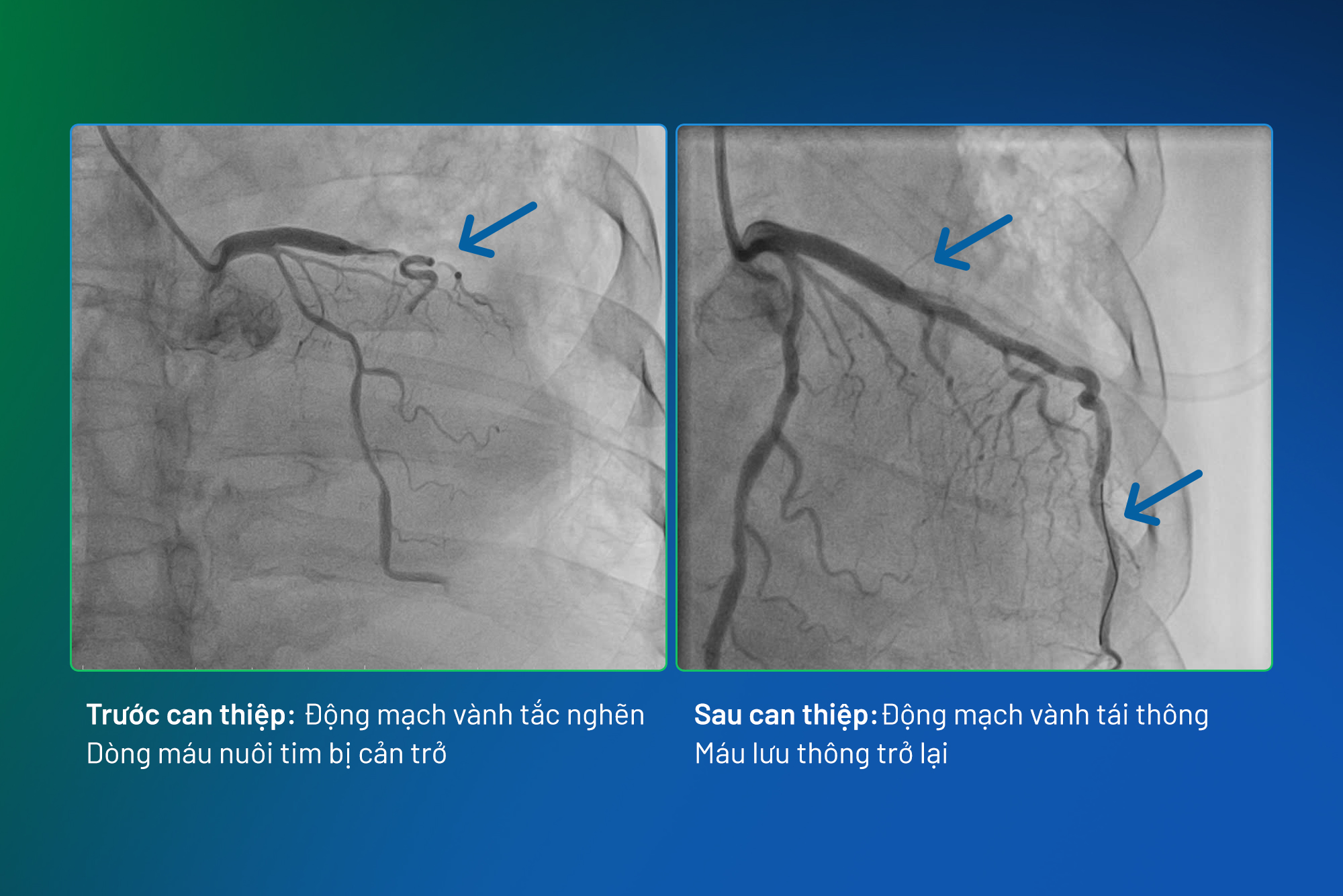 Cứu sống bệnh nhân nhồi máu cơ tim cấp giữa