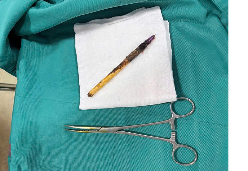 Cơ quan chức năng vào cuộc vụ phụ huynh phản ánh con bị nhét bút vào hậu môn- Ảnh 2.