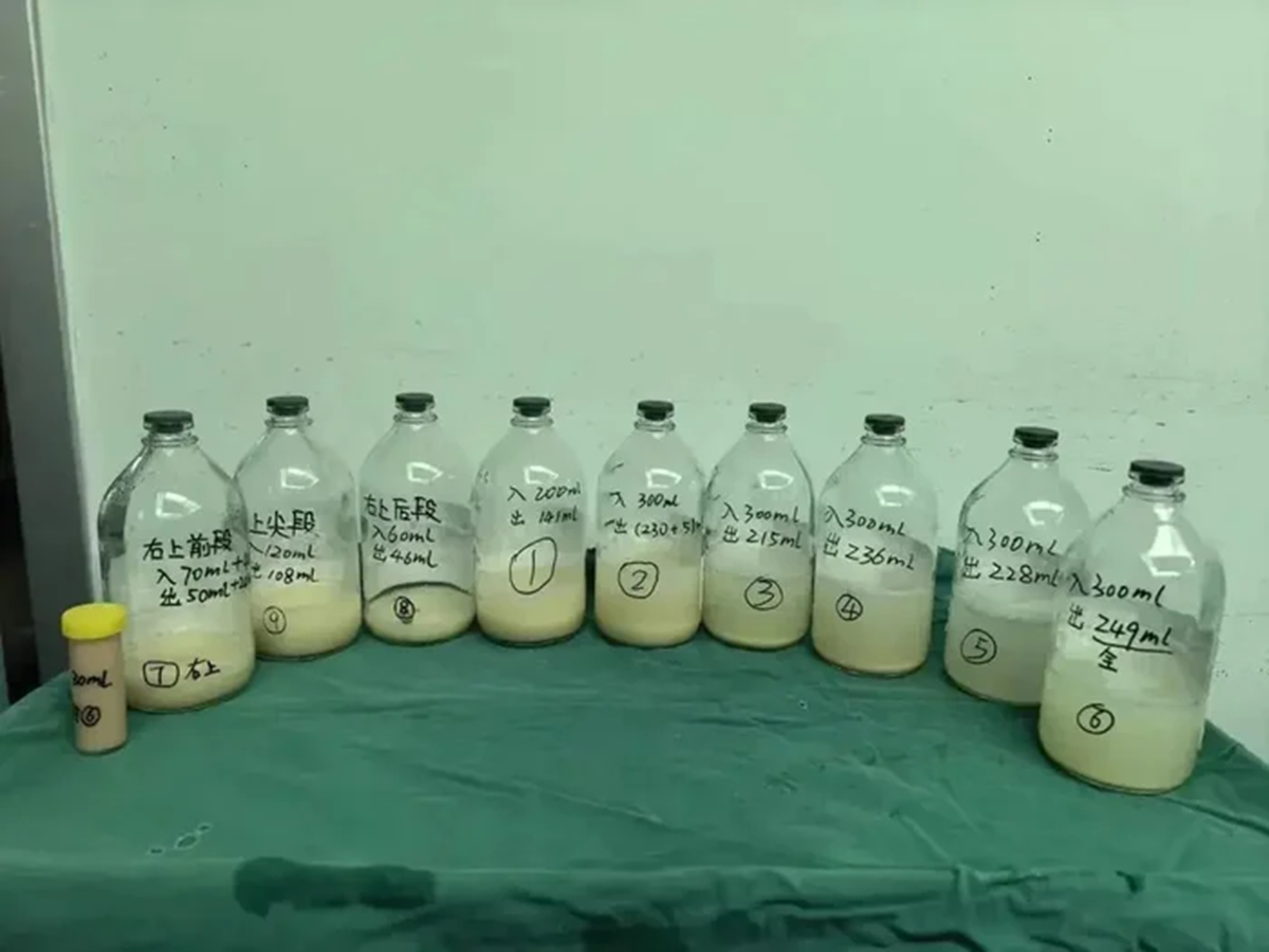 Bé gái 6 tuổi ho suốt 2 tháng, bác sĩ lấy thứ 