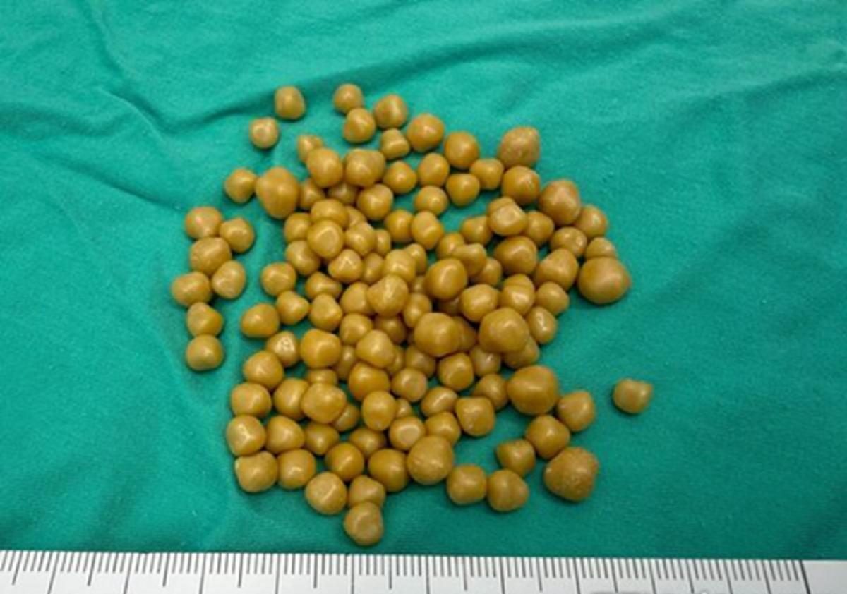 Đau bụng suốt 1 tháng, người phụ nữ 38 số khi bác sĩ lấy ra thứ 