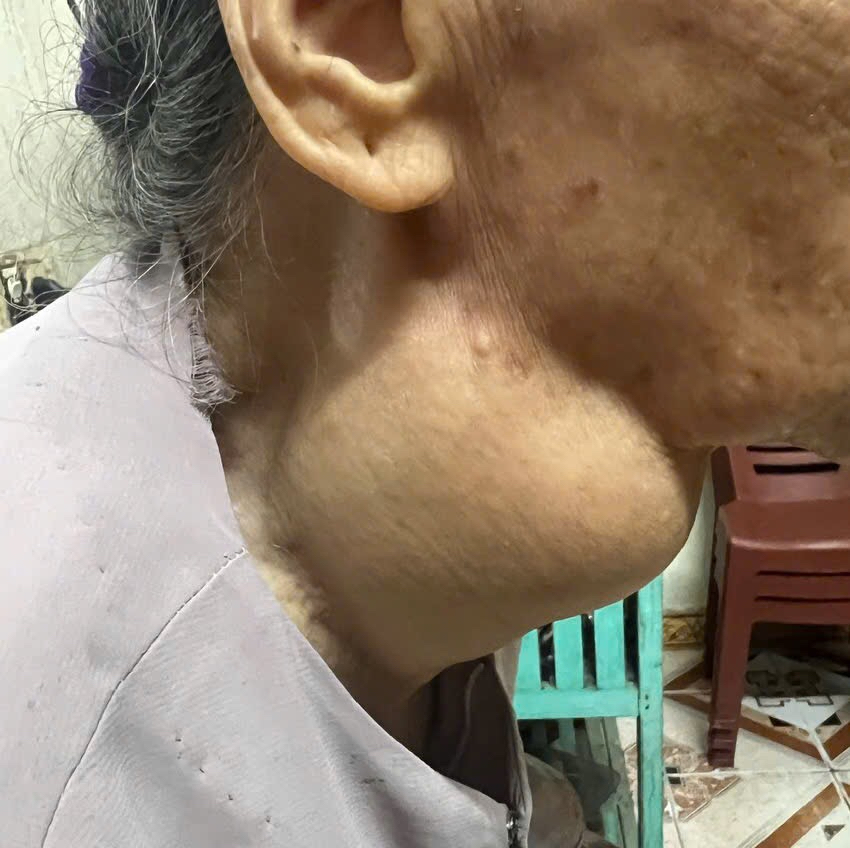 Vinmec Hạ Long giải cứu cụ bà 88 tuổi bị khối u giáp khổng lồ chèn ép đường thở suốt 18 năm- Ảnh 1.