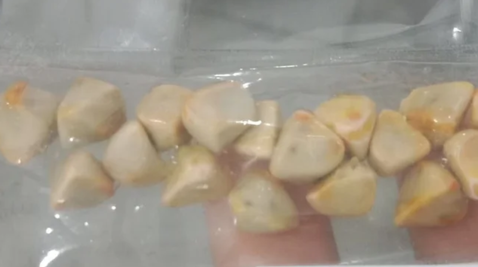 Uống trà đá đều đặn suốt 10 năm, người phụ nữ sốc khi bác sĩ lấy ra thứ
