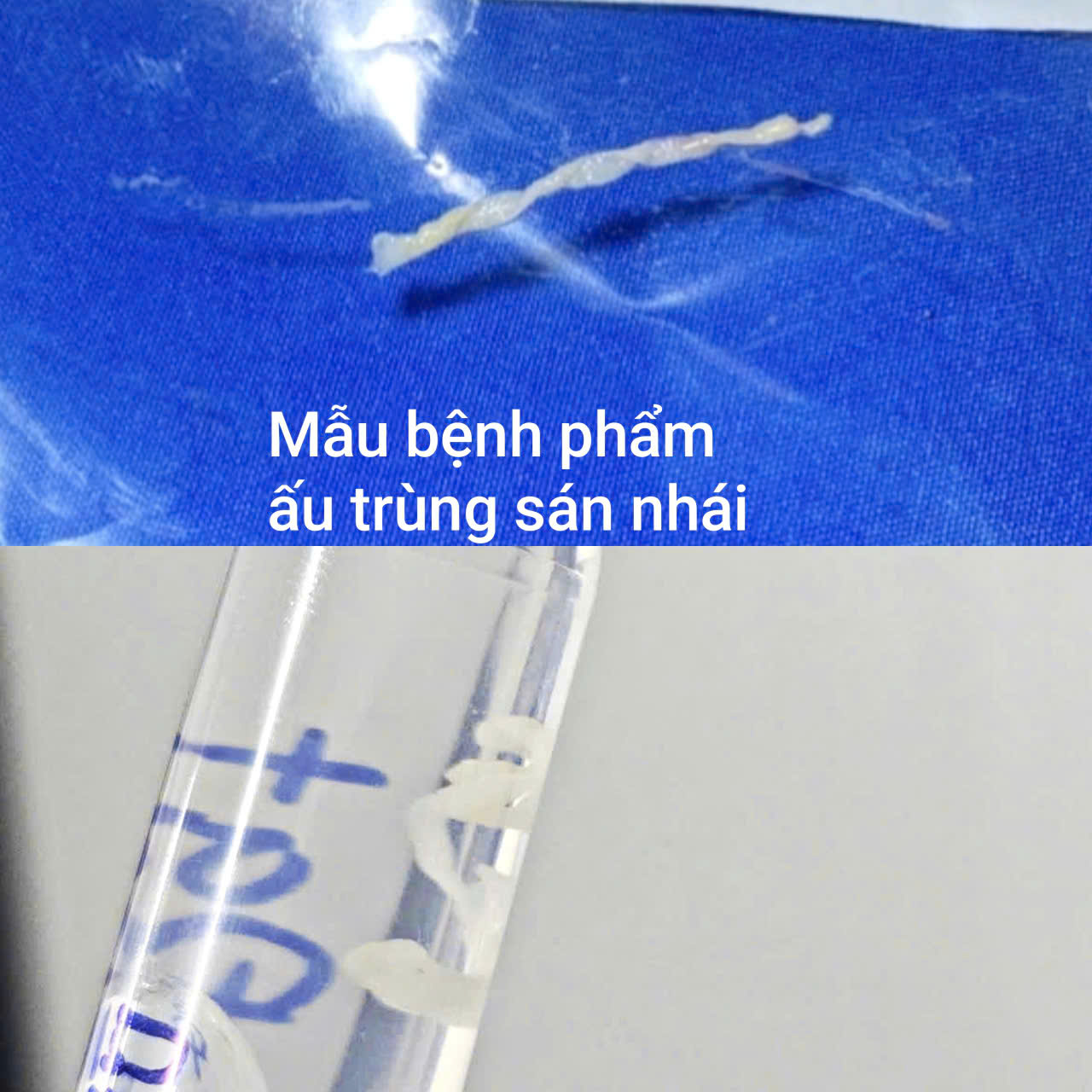 Nam thanh niên nhiễm ấu trùng sán nhái hiếm gặp sau lần tắm suối - Ảnh 1.