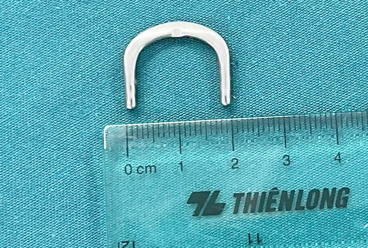 Bé 3 tuổi đau bụng, bác sĩ phát hiện “vật lạ” mắc trong tá tràng - Ảnh 2.