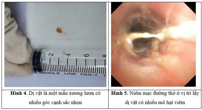 Bé trai 3 tuổi ho suốt một tháng, gia đình sửng sốt khi biết lý do - Ảnh 2.