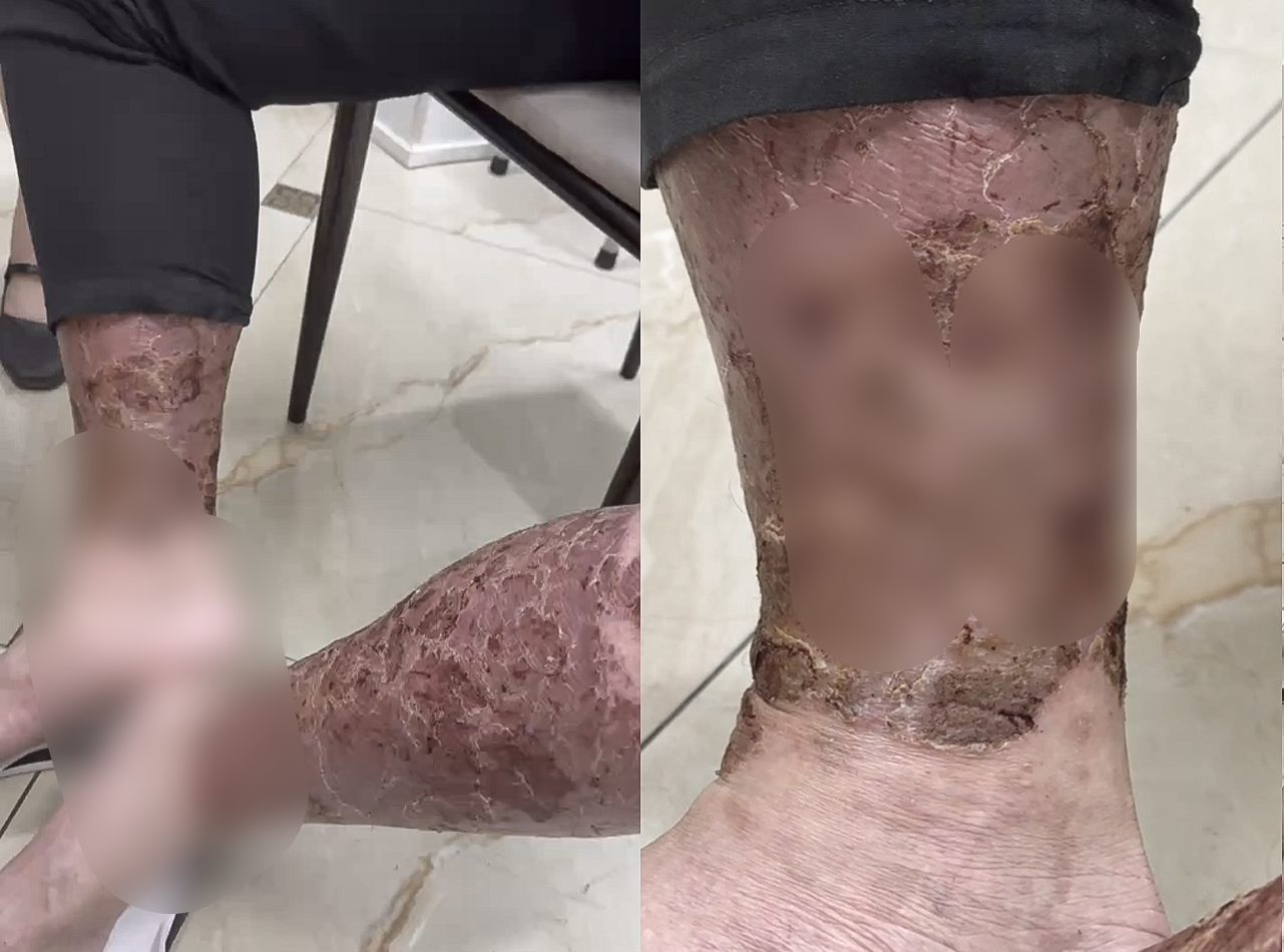 Ngứa kéo dài khiến người bệnh lạm dụng rượu để ngủ, bác sĩ cảnh báo hệ lụy- Ảnh 1.
