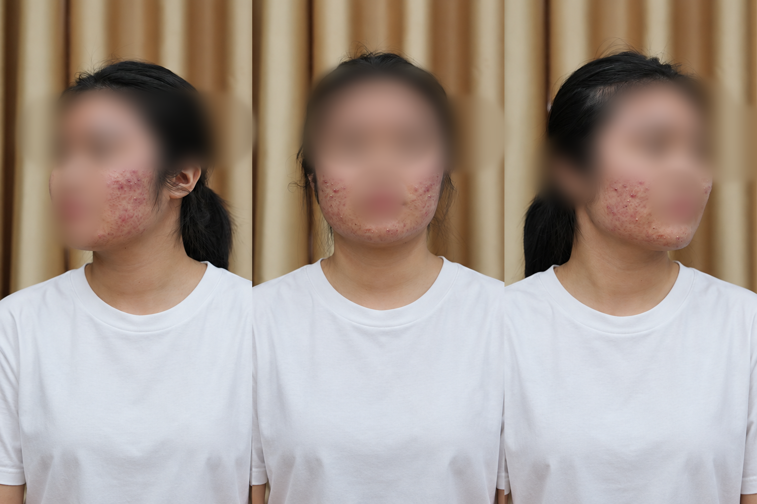 Làm đẹp cấp tốc mùa tựu trường, nhiều nữ sinh mặt sưng như ong đốt - Ảnh 1.