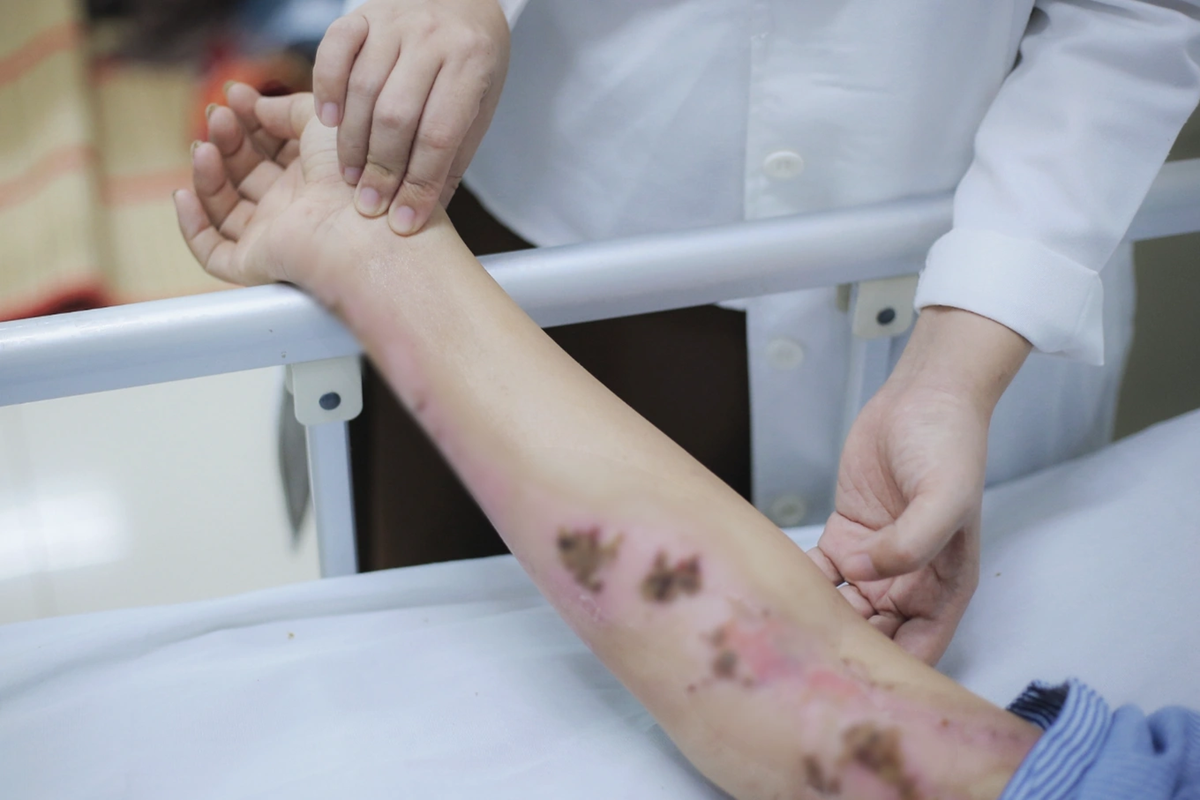Đang đi ngoài đường, cô gái 33 tuổi bị sét đánh cháy sém cổ - Ảnh 1.
