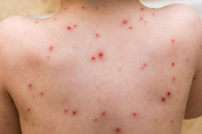 Đời sống - Hà Nội: Dịch thủy đậu bùng phát mạnh, sắp chạm ngưỡng 1.000 ca