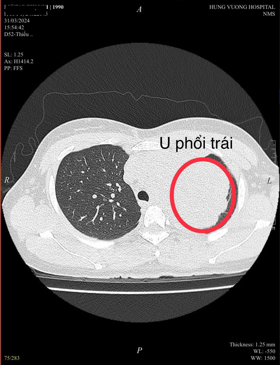 Dân sinh - Đi khám vì đau bả vai, người phụ nữ trẻ mắc ung thư phổi