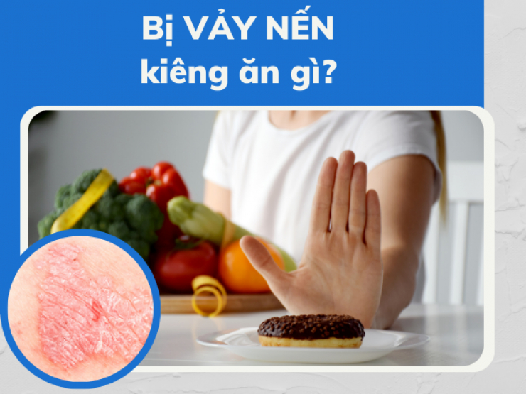 Người mắc bệnh vảy nến kiêng ăn gì để nhanh cải thiện?