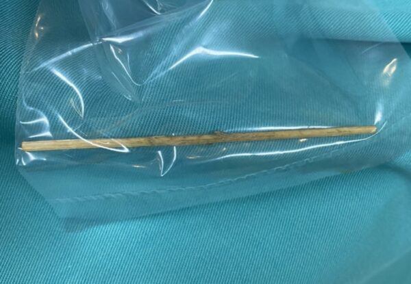 Đời sống - Người đàn ông thủng đại tràng vì thói quen nhiều người mắc phải