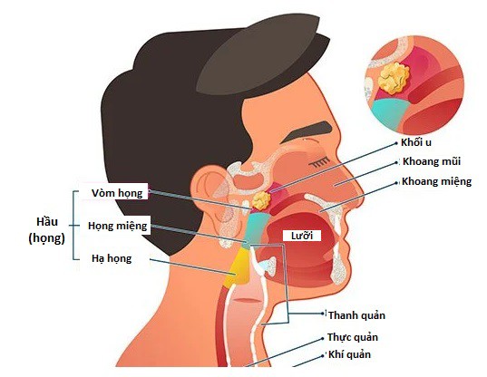 Sức khỏe - Dấu hiệu nhận biết sớm ung thư vòm họng