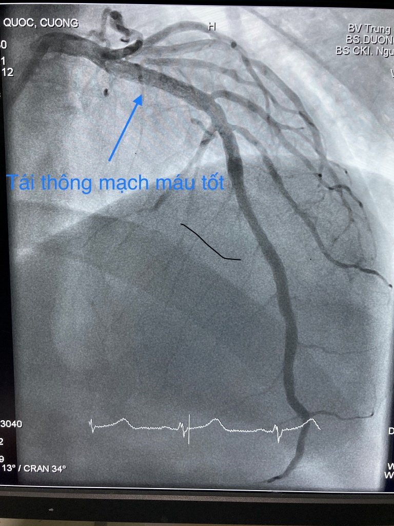 Sức khỏe - Cứu sống bệnh nhân “thập tử nhất sinh” với chi phí 0 đồng (Hình 3).