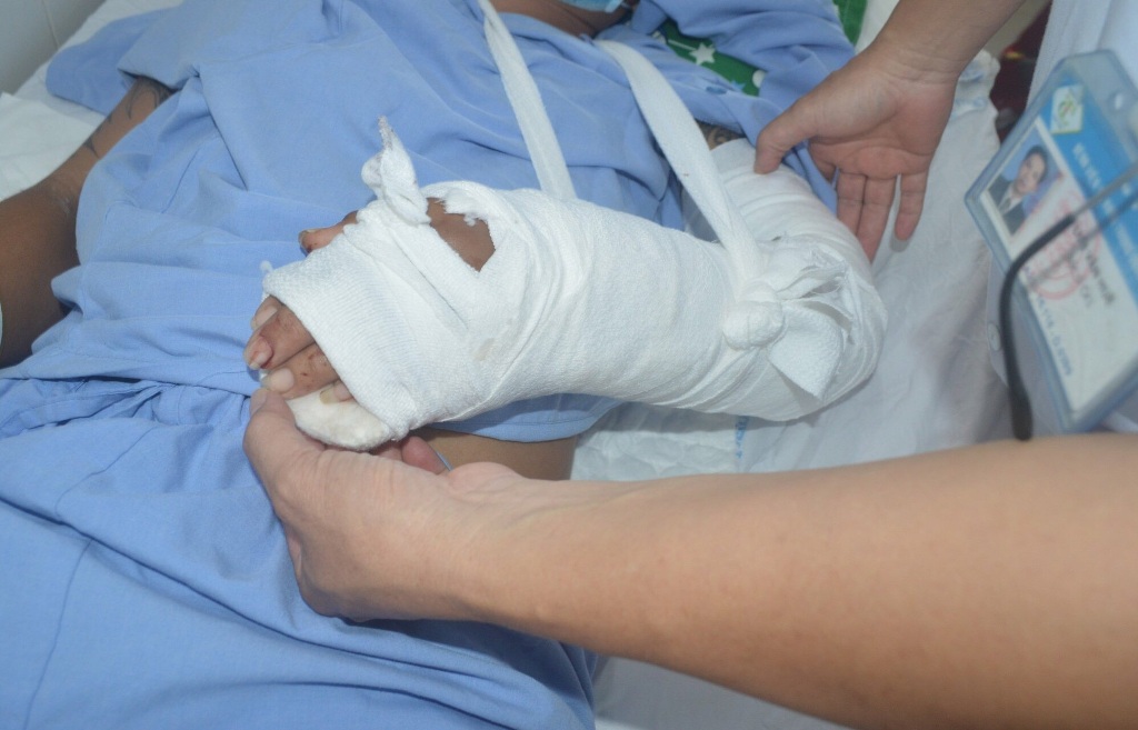 Sức khỏe - Hơn 3 giờ phẫu thuật nối thành công bàn tay bệnh nhân bị đứt lìa (Hình 2).