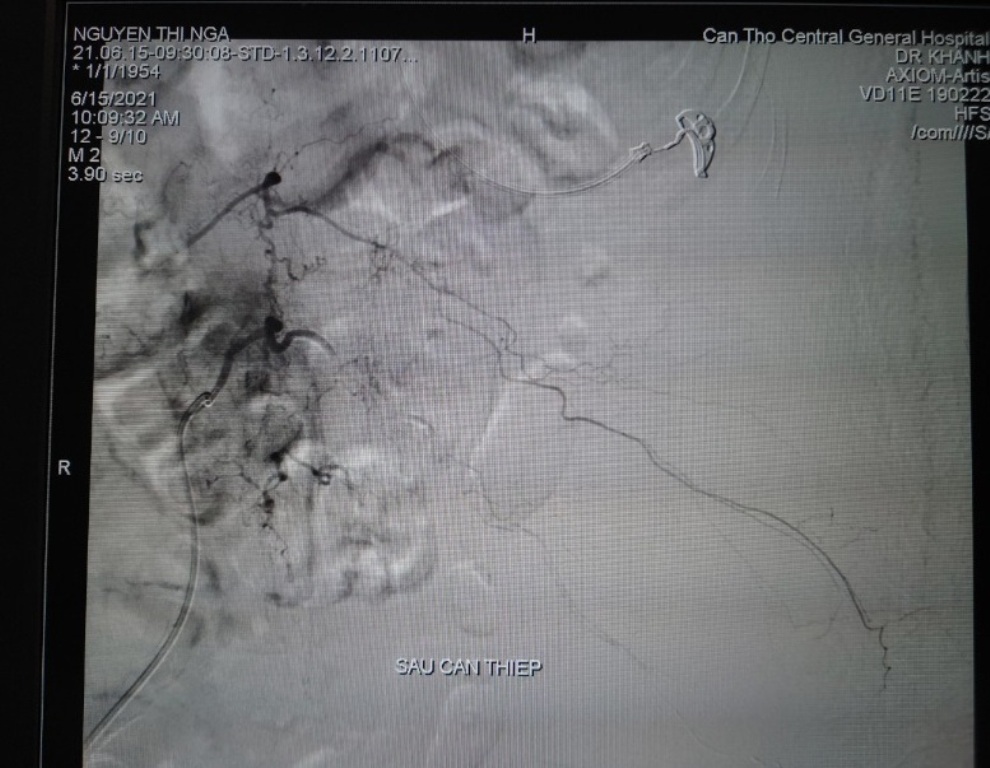 Sức khỏe - 30 phút can thiệt nội mạch cứu bệnh nhân vỡ mạch thắt lưng nguy kịch (Hình 3).