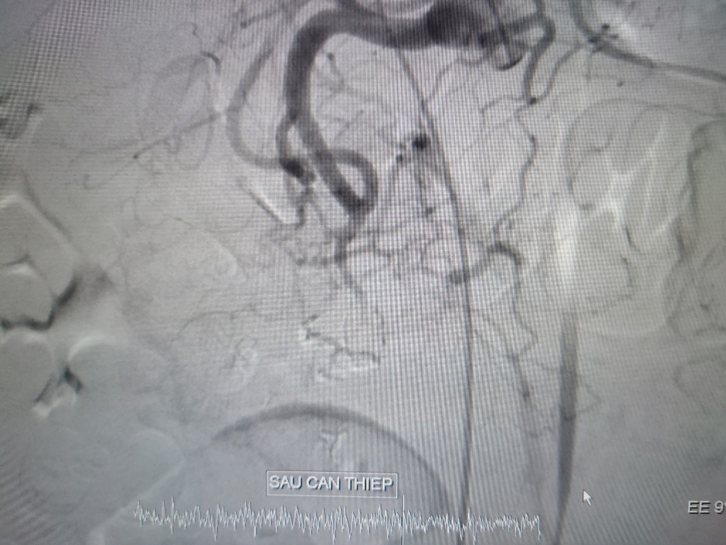 Sức khỏe - Cứu sống bệnh nhân vỡ phình động mạch vị tá tràng hiếm gặp nguy kịch (Hình 2).