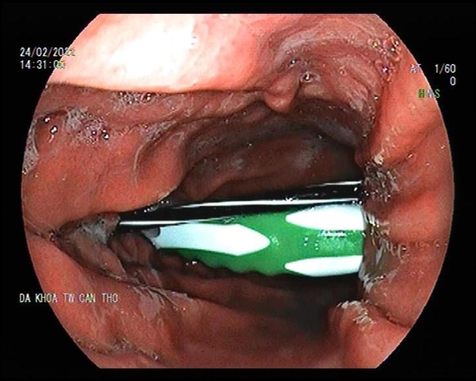 Sức khỏe - Hy hữu nội soi lấy bàn chải đánh răng và ruột bút bi trong dạ dày (Hình 2).