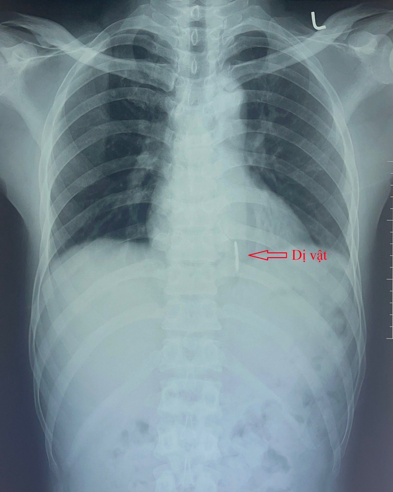 Sức khỏe - Cứu sống bệnh nhân tai nạn lao động hy hữu với vết thương ở tim