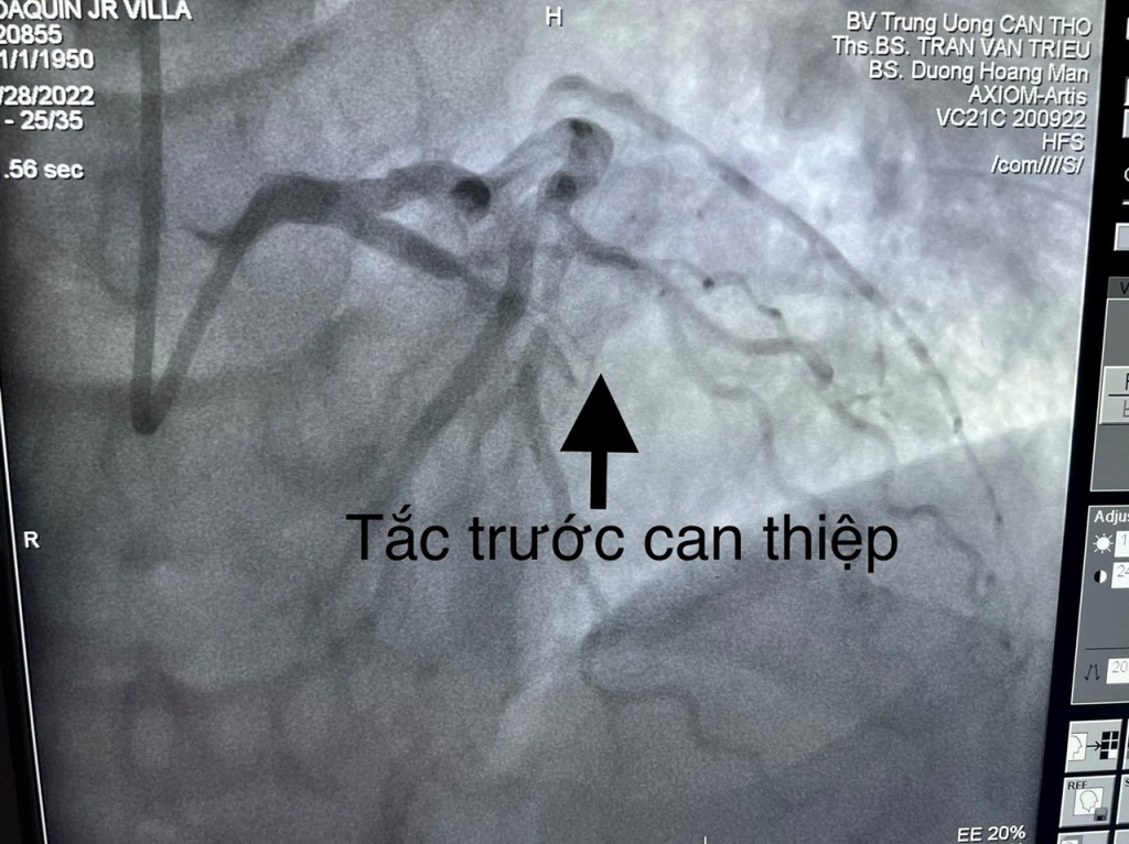 Sức khỏe - Cứu sống bệnh nhân quốc tịch Mỹ nhồi máu cơ tim cấp nguy kịch