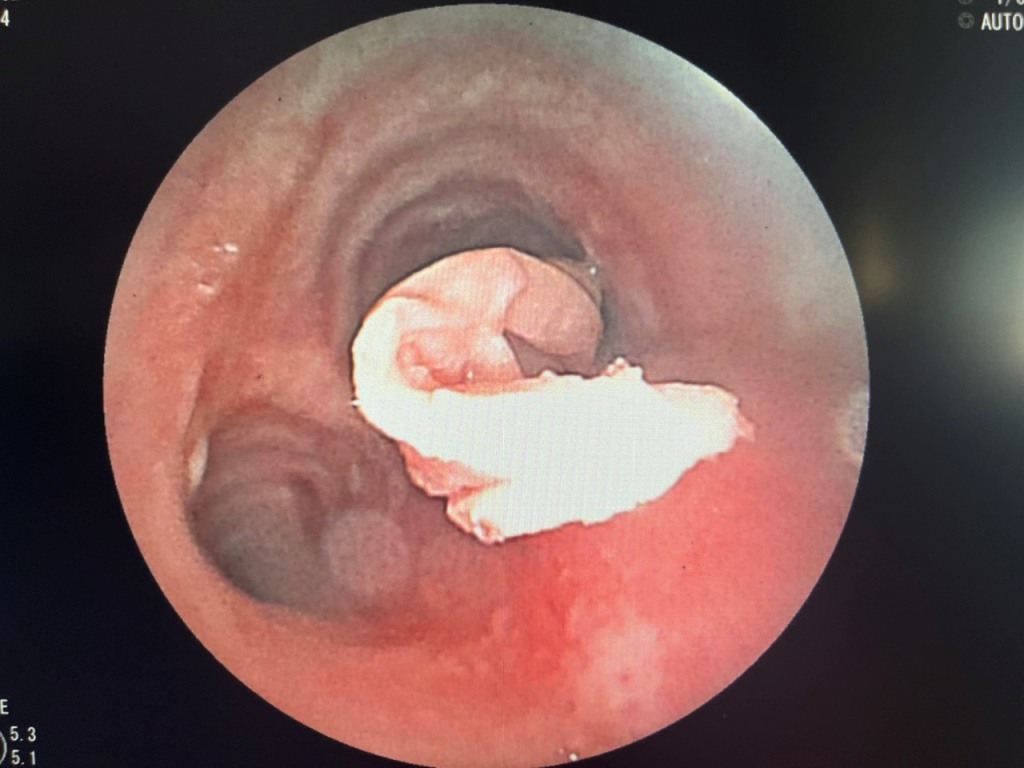 Sức khỏe - Nội soi cấp cứu lấy dị vật khăn giấy trong phế quản bệnh nhân ung thư