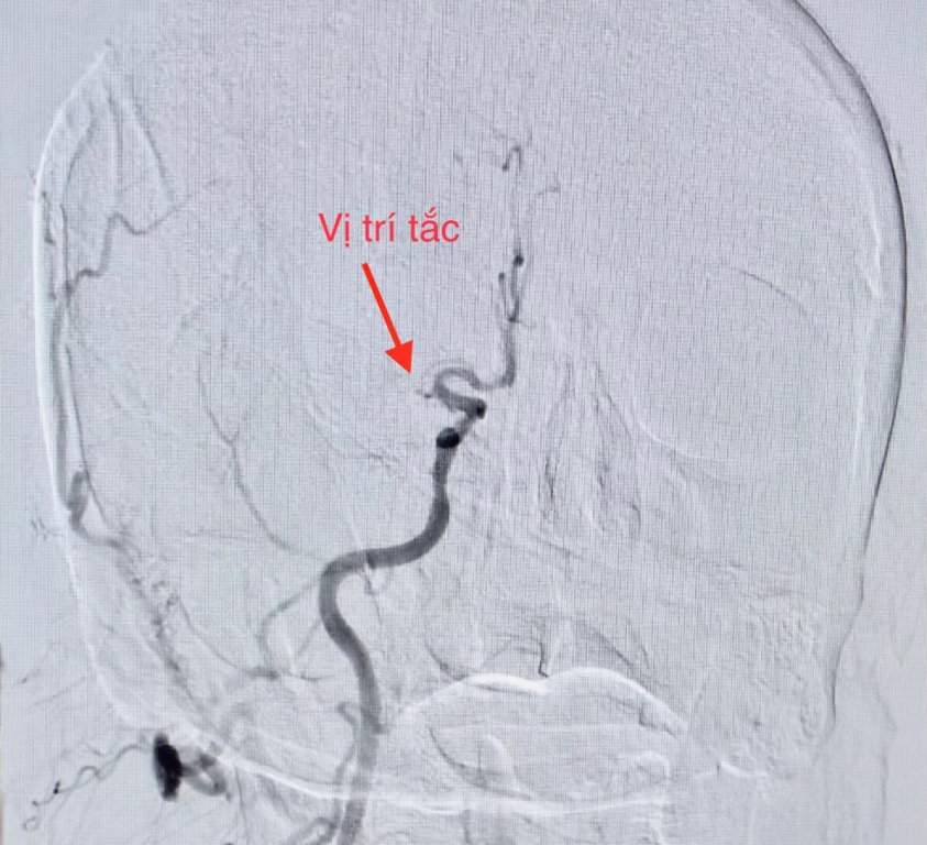 Sức khỏe - Phối hợp cứu sống bệnh nhân cùng lúc nhồi máu cơ tim và đột quỵ  (Hình 3).