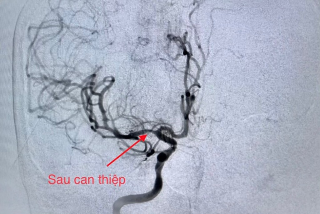 Sức khỏe - Phối hợp cứu sống bệnh nhân cùng lúc nhồi máu cơ tim và đột quỵ  (Hình 4).