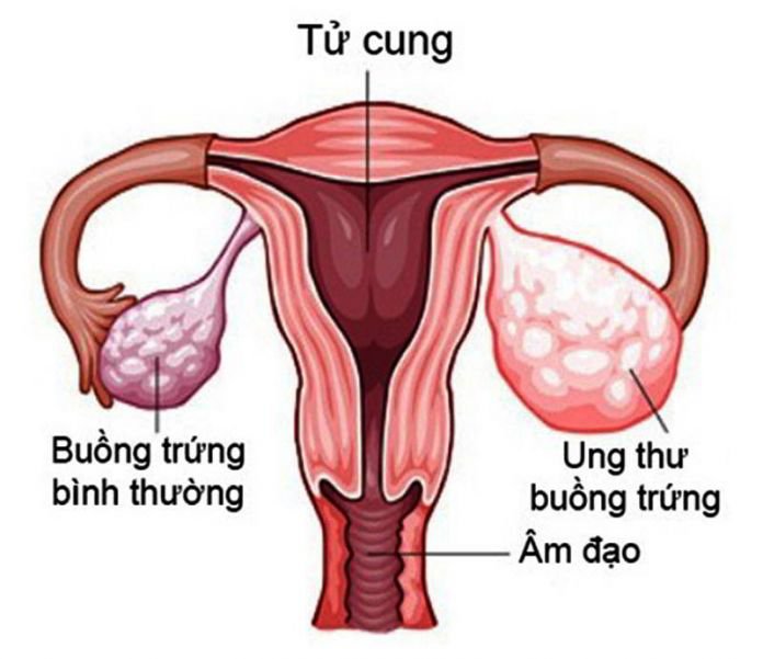 Sức khỏe - Căn bệnh ung thư phụ nữ hay gặp phải có yếu tố di truyền