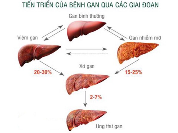 Sức khỏe - Căn bệnh ung thư nhiều người mắc nhất ở Việt Nam và cách phòng ngừa (Hình 2).