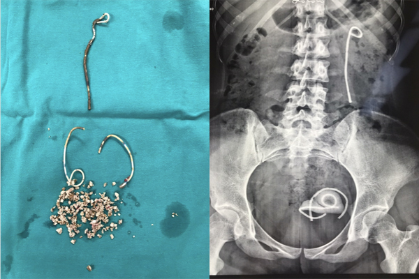 Sức khỏe - Bỏ quên stent 30cm trong bụng cô gái 25 tuổi suốt 5 năm