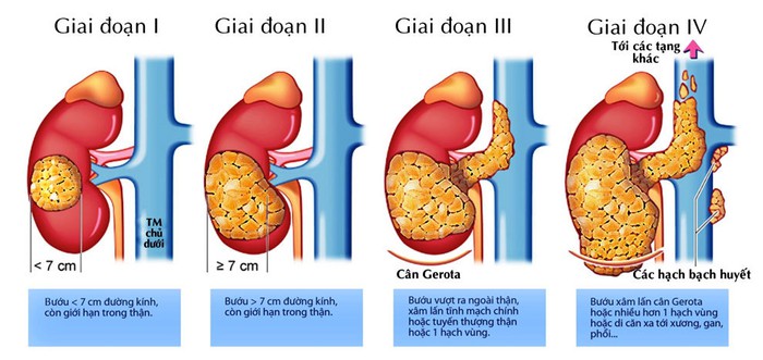 Sức khỏe - Bệnh ung thư NSƯT Mai Ngọc Căn mắc nguy hiểm thế nào? (Hình 2).