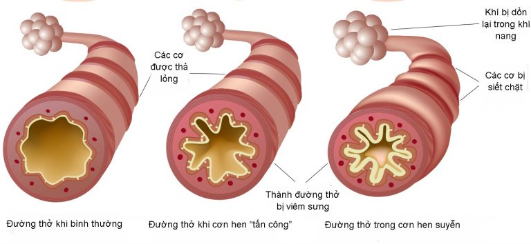 Sức khỏe - Phòng bệnh hen phế quản: 6 phương pháp cực hiệu quả cho trẻ trong ngày rét đậm (Hình 2).