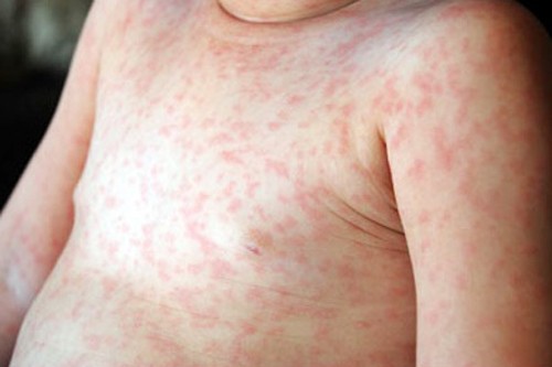 Tư vấn - Sởi, rubella vào mùa, làm gì để con bạn không mắc bệnh?