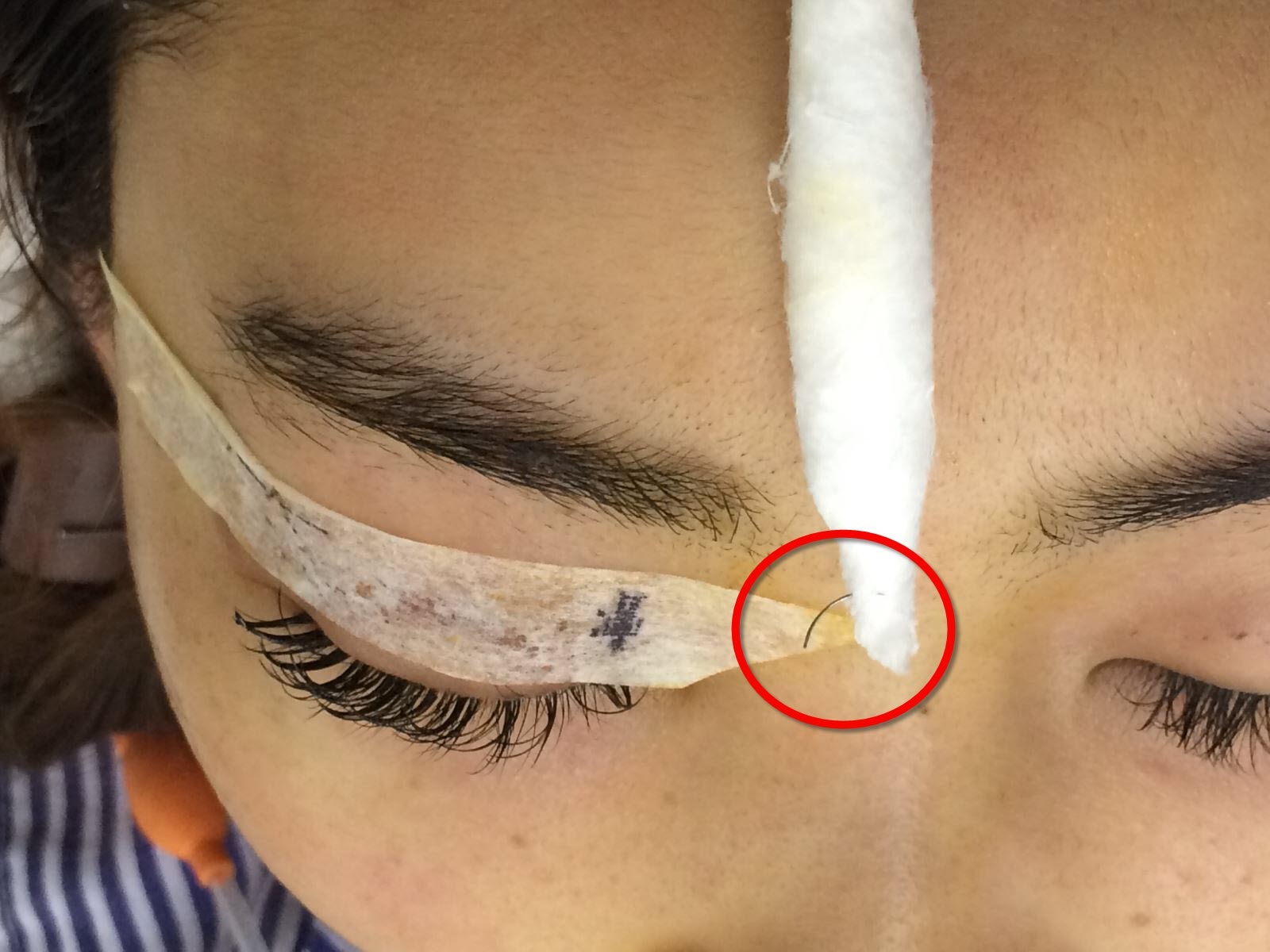 Sức khỏe - Tiêm filler dẫn đến mù, nhấn mí thì kim “đi lạc”