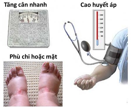 Sức khỏe - Chuyên gia mách cách đề phòng tai biến tiền sản giật cực kỳ nguy hiểm đối với bà bầu