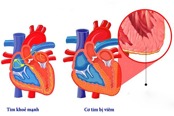 Sức khỏe - Bệnh viêm cơ tim hay gặp ở người trẻ tuổi (Hình 2).