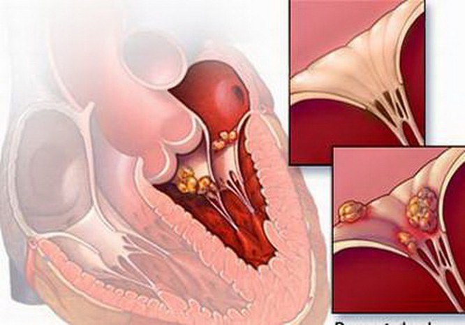 Sức khỏe - Bệnh viêm cơ tim hay gặp ở người trẻ tuổi