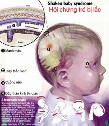 Sức khỏe - Bế trẻ không đúng cách có thể gây hội chứng rung lắc nguy hiểm