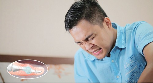 Tư vấn - Vì sao người mắc bệnh Gout ngày càng trẻ hóa?