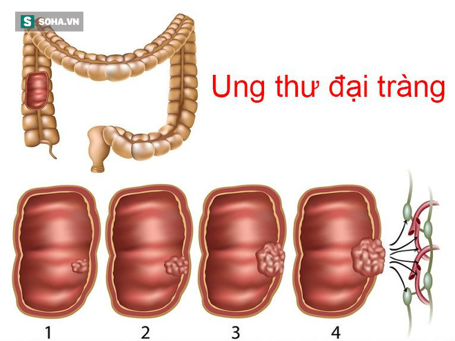 Đời sống - Phòng bệnh ung thư đại trực tràng: Quan trọng nhất là chế độ ăn uống và lối sống (Hình 2).