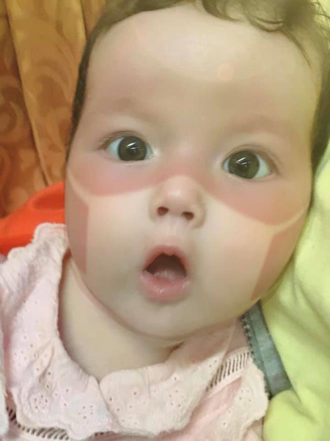 Đời sống - Nổi sóng mạng: Phát sốt với loạt ảnh em bé bị cháy nắng, in hình khẩu trang trên mặt (Hình 6).
