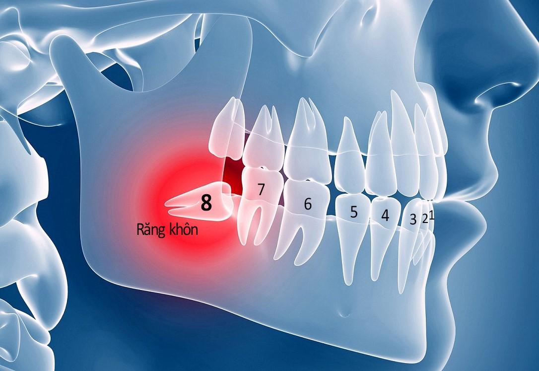 Đời sống - Nhổ răng khôn và những điều cần đặc biệt lưu ý