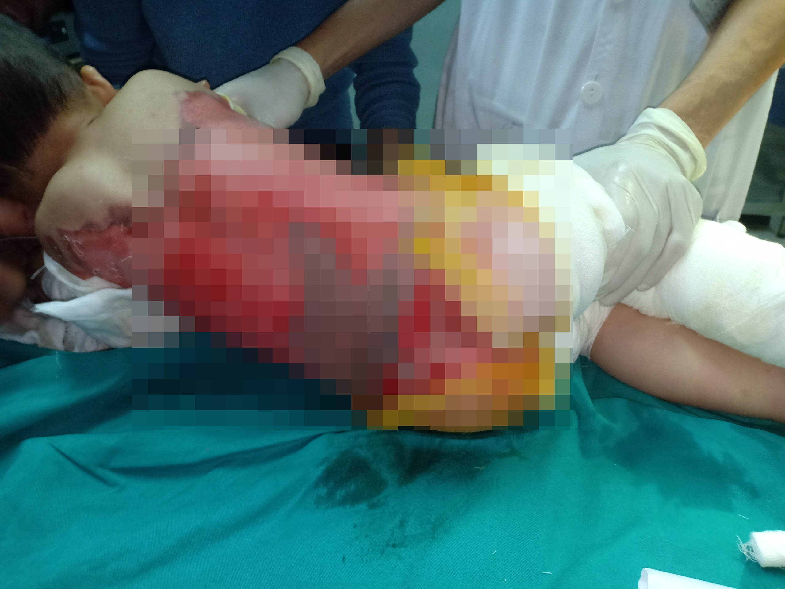 Sức khỏe - Trẻ bị bỏng nước sôi trong tình huống không ngờ: Bác sĩ khuyến cáo