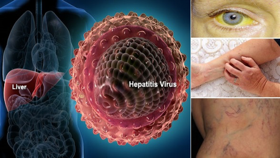 Tin nhanh - Chuyện của hàng triệu giấc mơ bị virus viêm gan B đánh cắp (Hình 3).