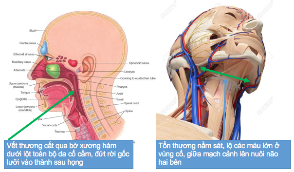 Sức khỏe - Cấp cứu thành công nữ phụ hồ rơi từ tầng 2 xuống đất, bị vật sắc cắt ngang vùng hạ họng