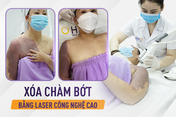 Sức khỏe - Chàm bớt chỉ có thể chữa được bằng tổ hợp laser công nghệ cao? (Hình 2).